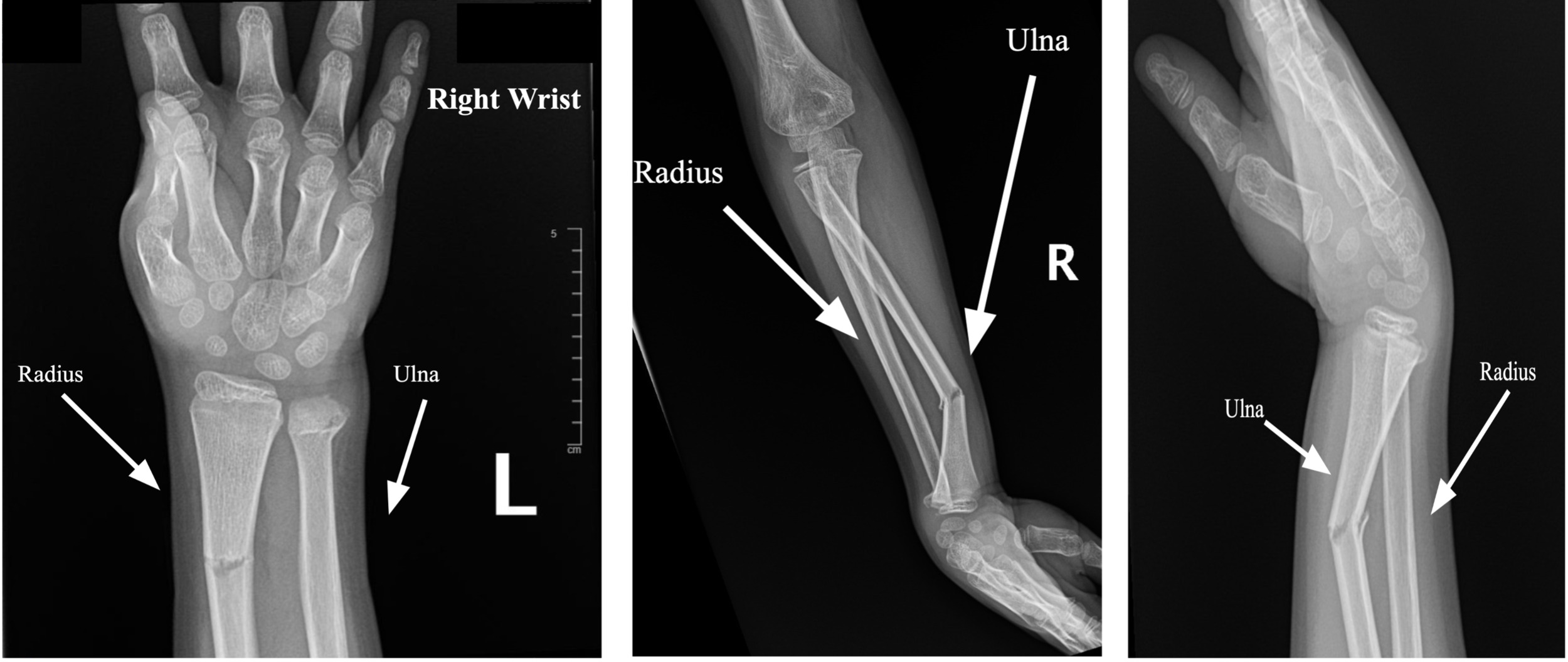 Comminuted Displaced And Angulated Distal Radial And Ulnar 