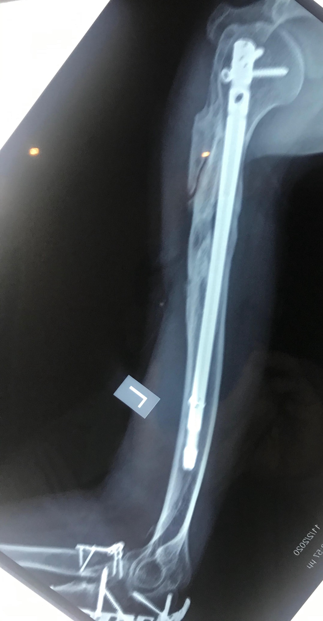 Isolated Ulnar Shaft Fracture - Trauma - Orthobullets