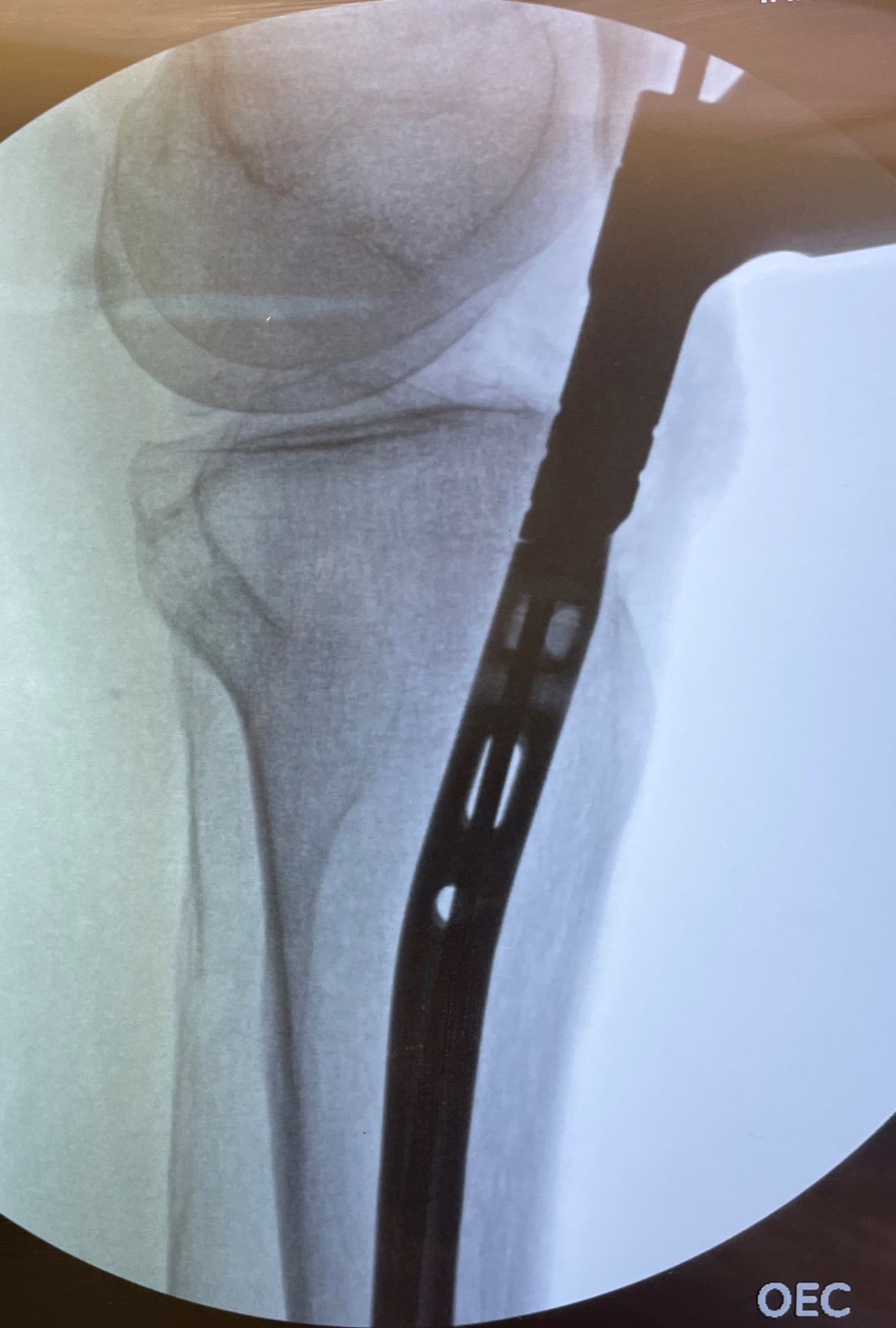 JBJS: Trifocal Tibial Bone Transport Using a Magnetic Intramedullary Nail