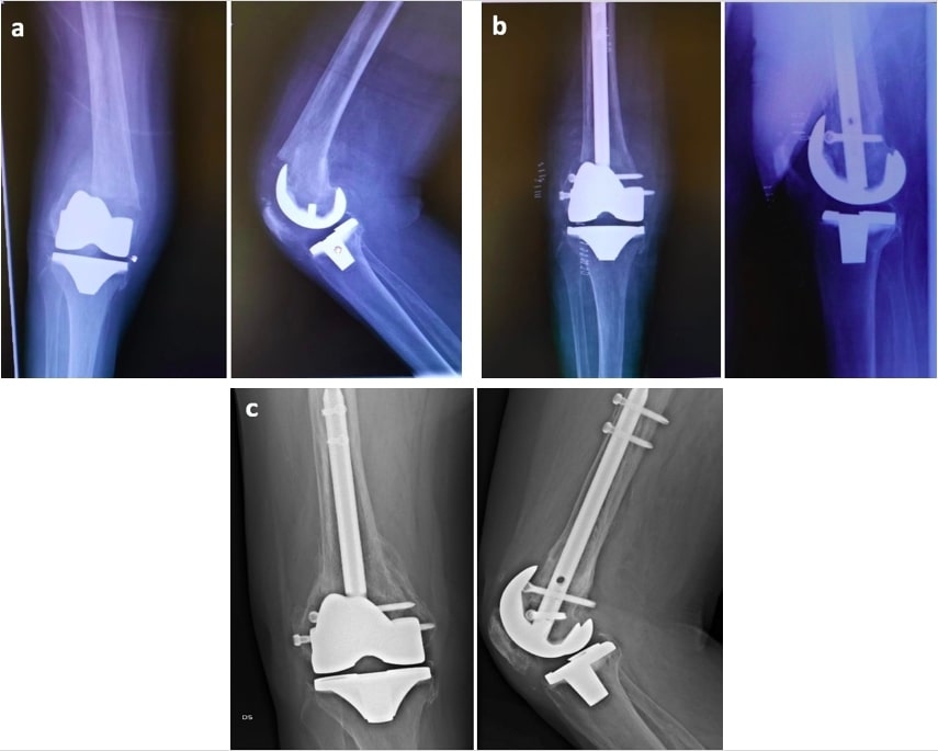 Radiograph of the right tibia.Tibial lengthening by combined... | Download  Scientific Diagram