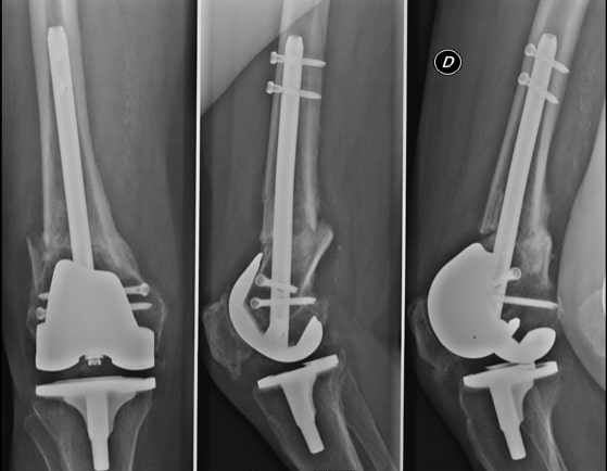Gamma Nail - Hip Fracture - Recovery and Physical Therapy