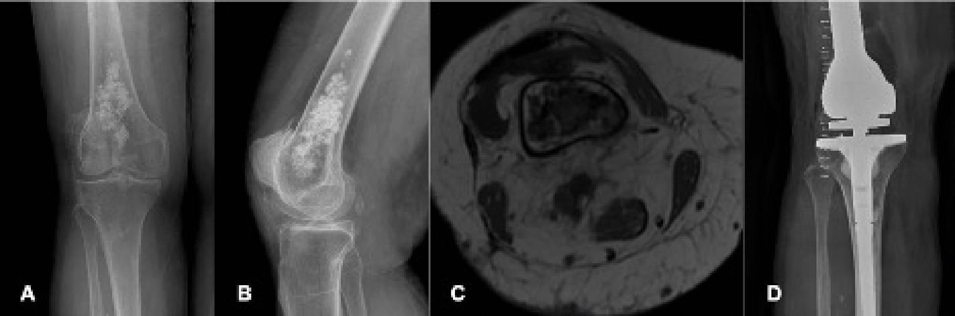 chondrosarcoma x ray