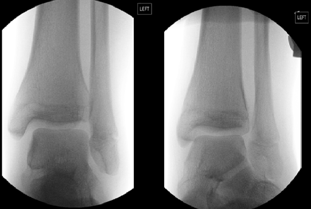 Bilateral ankle syndesmosis injury: a rare case report