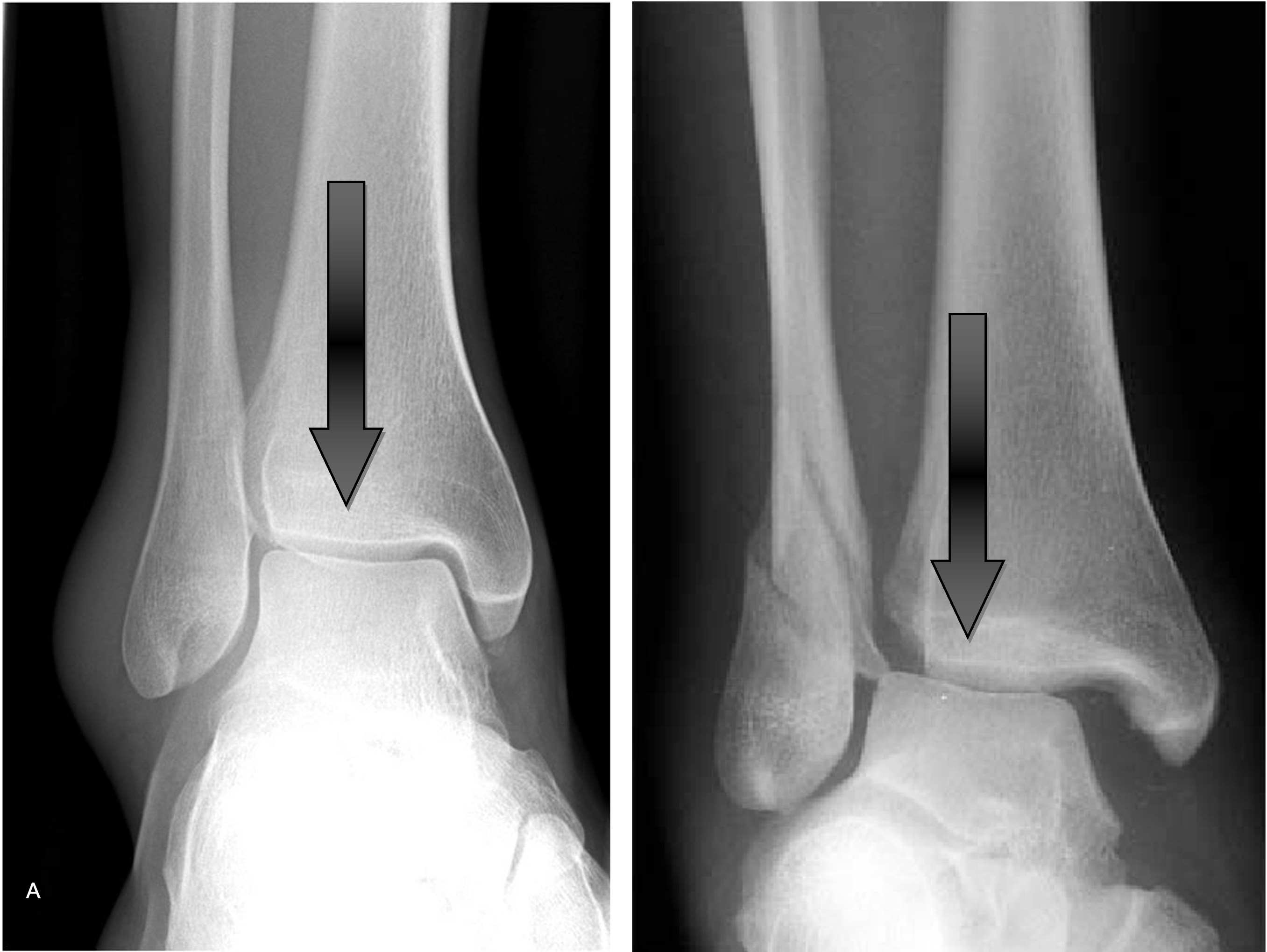 Radiographic analysis of adult ankle fractures using combined
