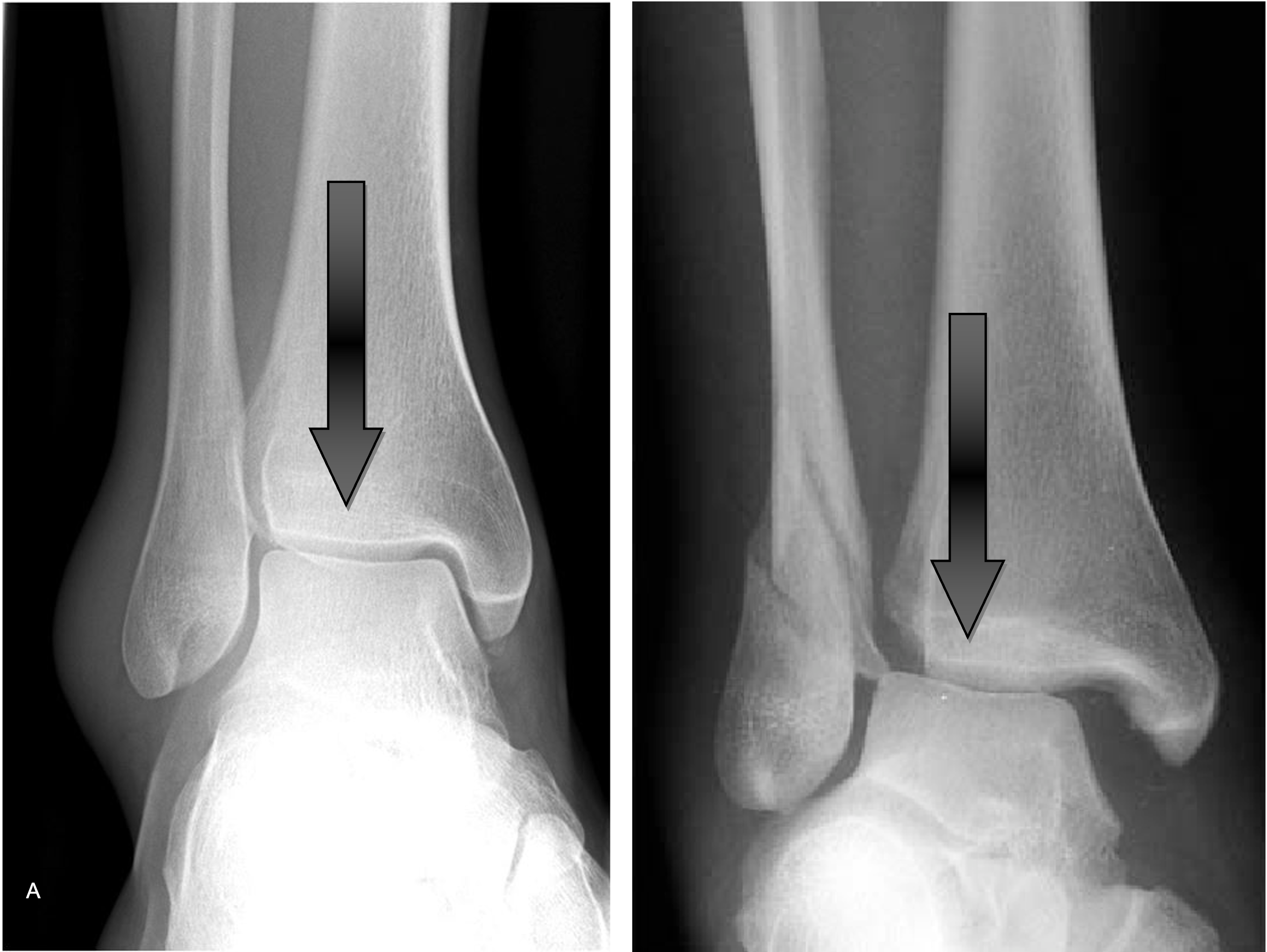 Stress Fracture Of The Talus - Ankle - Conditions - Musculoskeletal - What  We Treat 