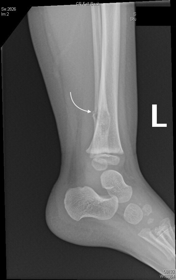 pathologic fracture x ray