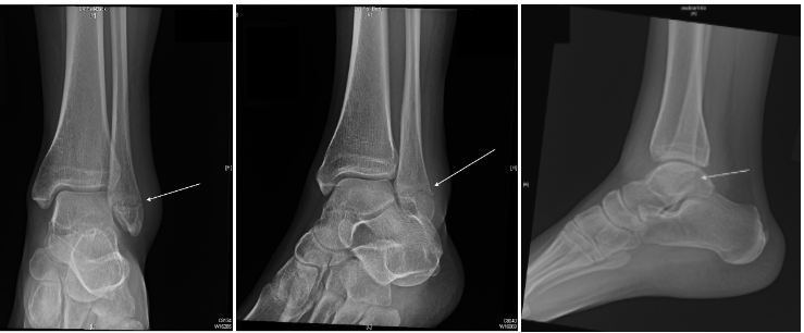 ser 4 right lateral malleolus fracture