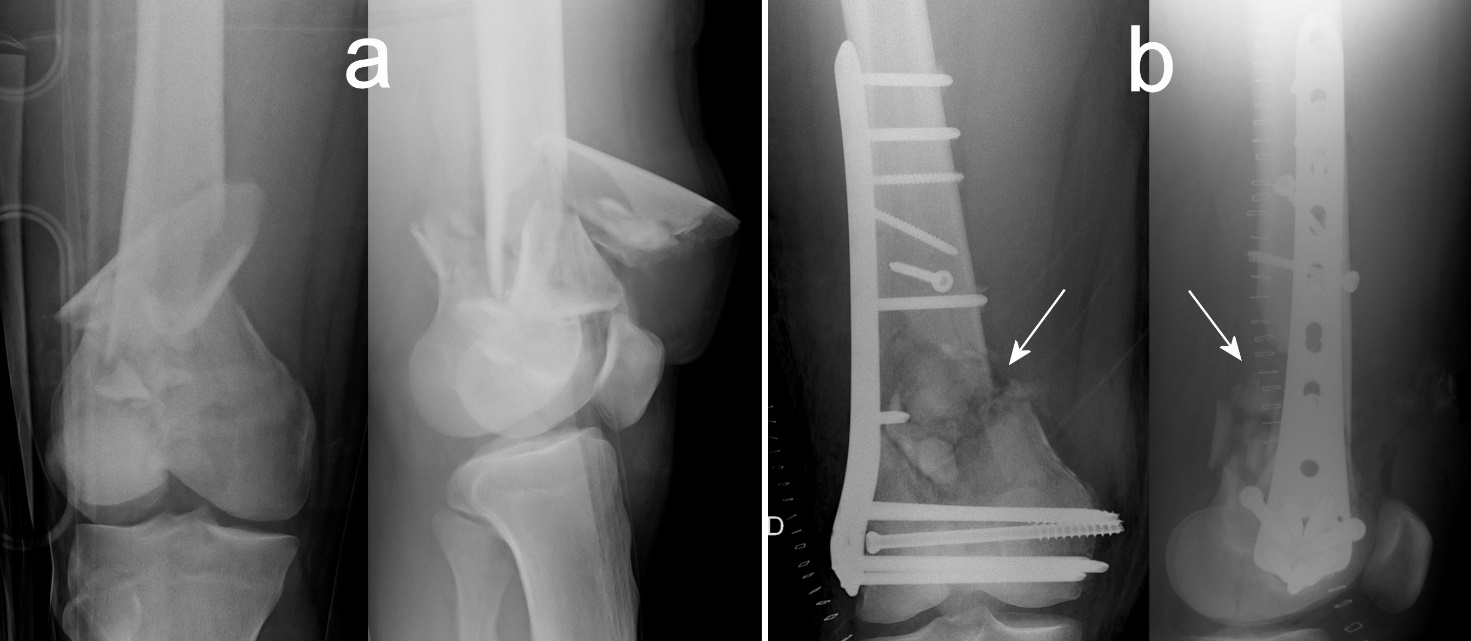 Comparison of sub trochanteric femur fracture treatment with intra  medullary proximal femur nail versus proximal femur nail with trochanteric  support plate - Indian J Orthop Surg