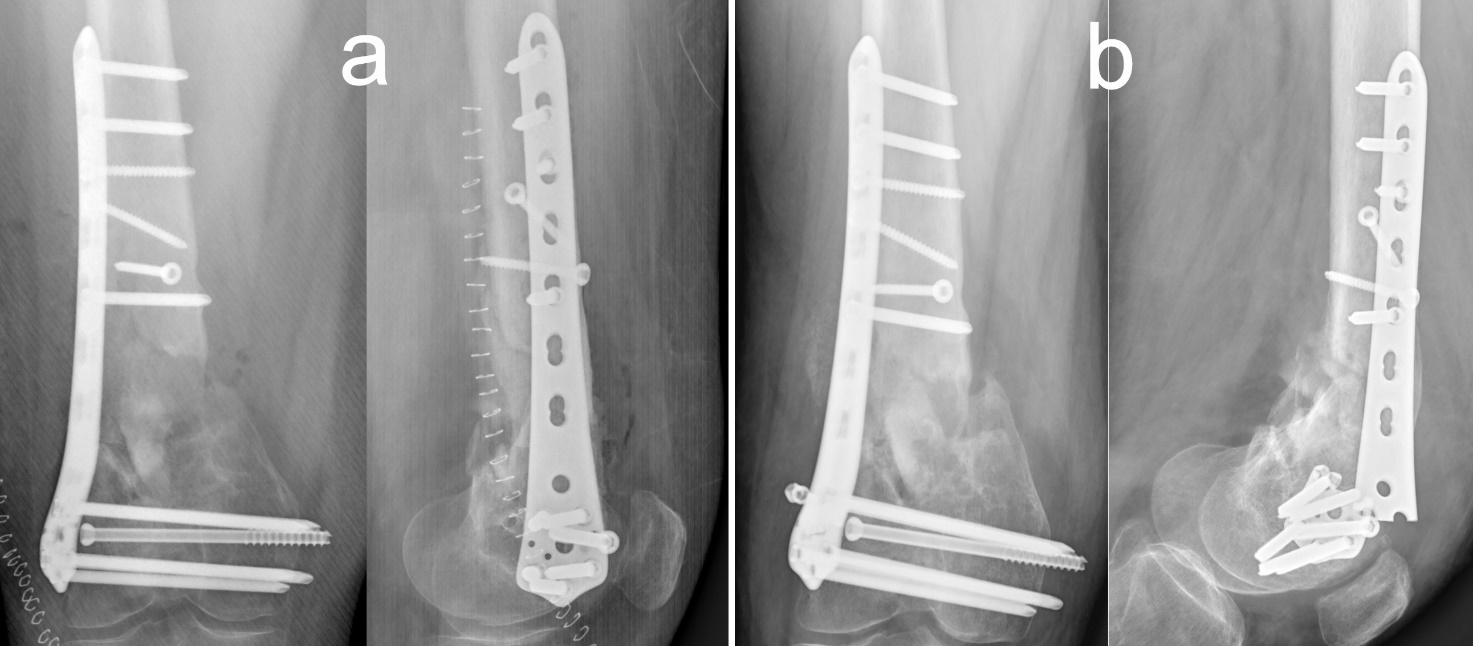 Long-term functional outcome of knee after antegrade versus retrograde  intramedullary nailing for femoral fracture El-Seedy AI, Zaki EM, El-Sheikh  IF, Sakr SA - Menoufia Med J