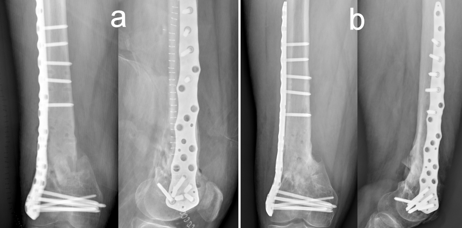 Early Results of Retrograde Expandable Nail Fixation of 29 Distal Femoral  Fractures - Ely Liviu Steinberg, Yacov Elis, Nadav Shasha, Elchanan Luger,  2011