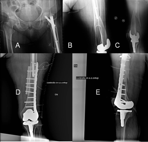 PPT - Case no.45-Delayed femur malunion and shortening treated with  distraction and exchange nailing PowerPoint Presentation - ID:4110812