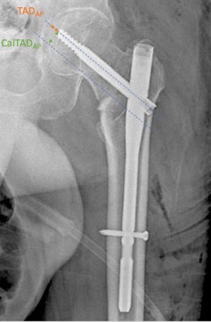 Cephalomedullary nailing for reverse oblique intertrochanteric fractures  31A3 AOOTA  Published in Orthopedic Reviews
