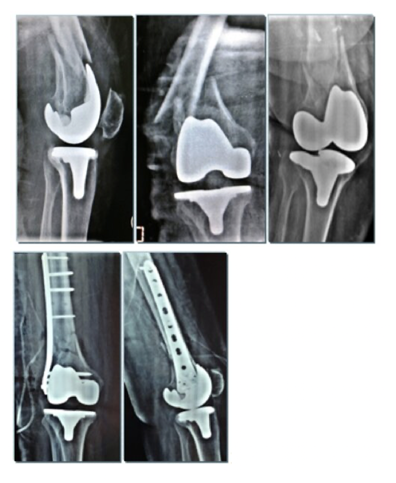 Plate osteosynthesis combined with bone cement provides the