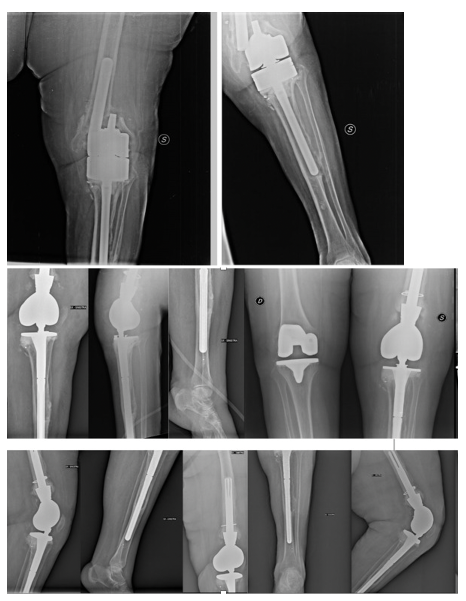 A-C Radiographic images and drawing of the tibia at 5 months followup... |  Download Scientific Diagram