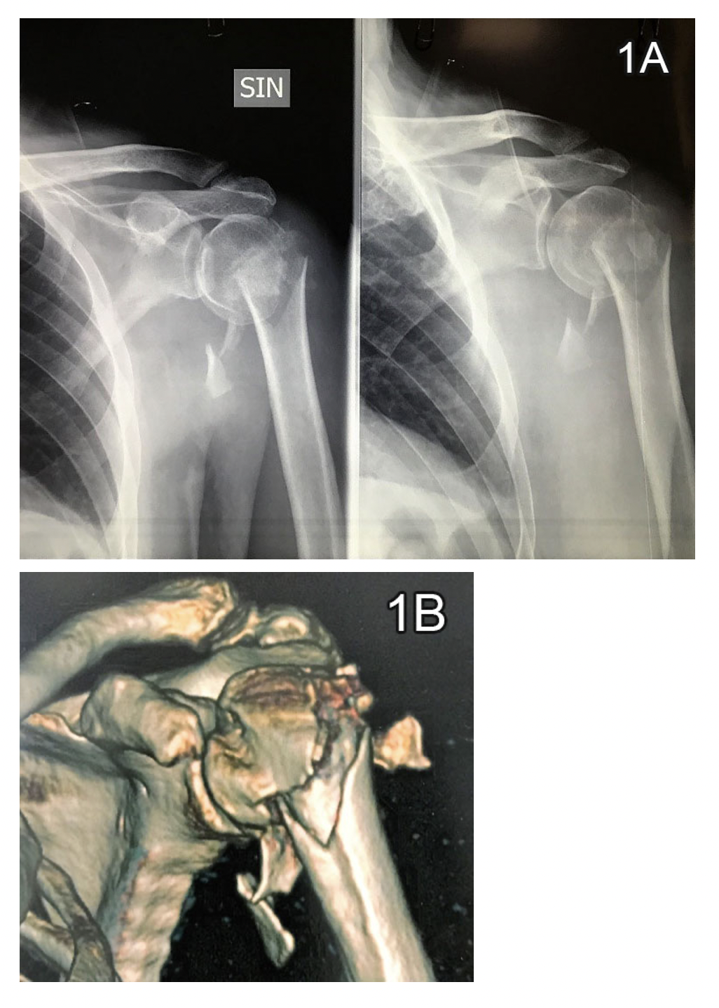 comminuted proximal humerus fracture