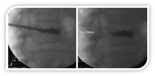 A lumbar compression fracture at L4 treated with a vertebral body stent