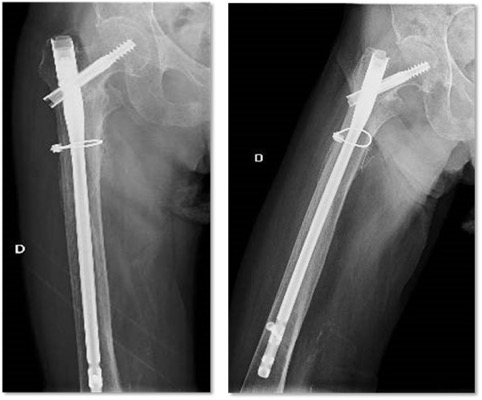 Subtrochanteric femoral fractures: A case series of 194 patients treated  with long and short intramedullary nails | Published in Orthopedic Reviews