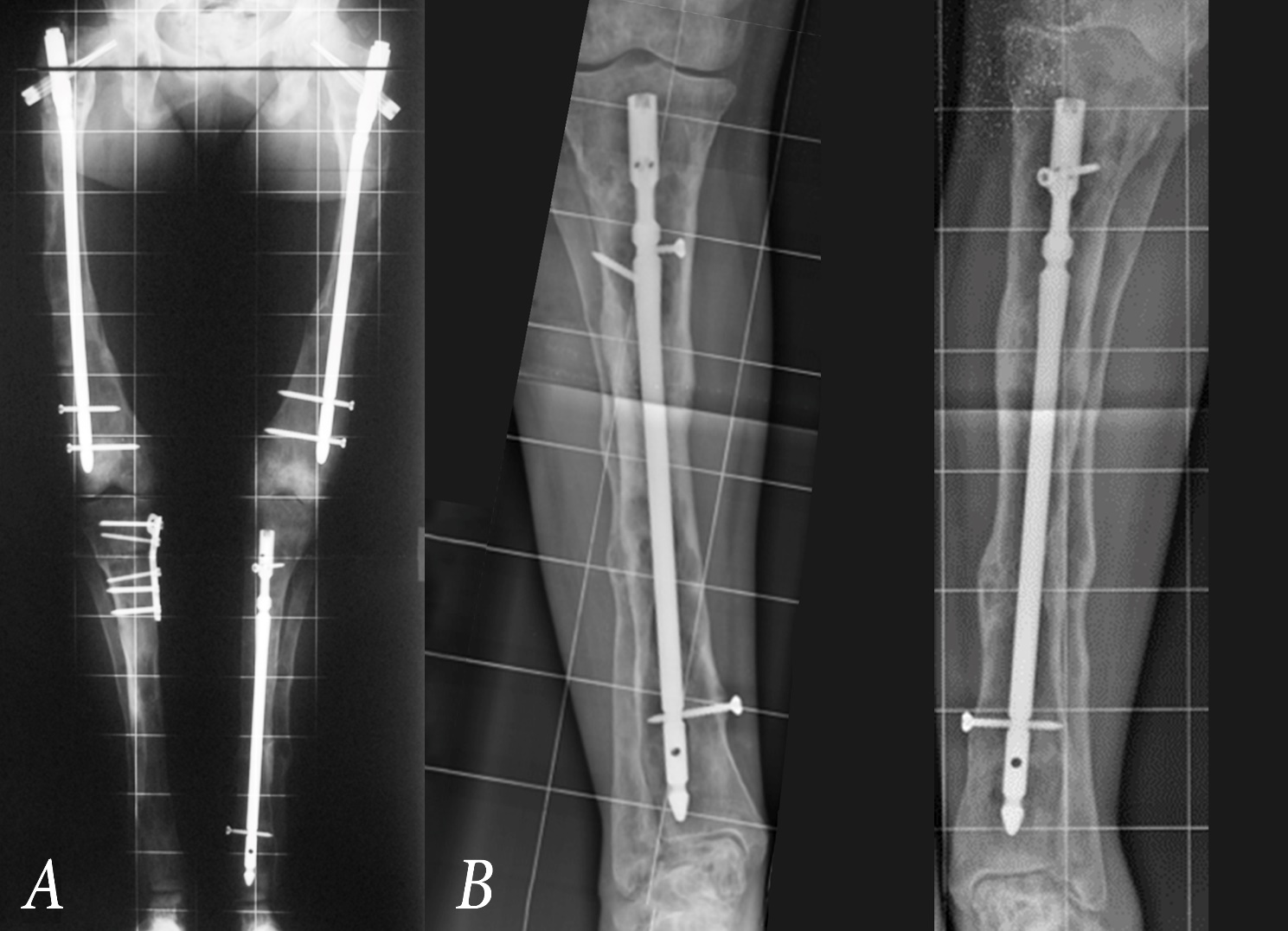 Acute correction and intramedullary nailing of aseptic oligotrophic and  atrophic tibial nonunions with deformity