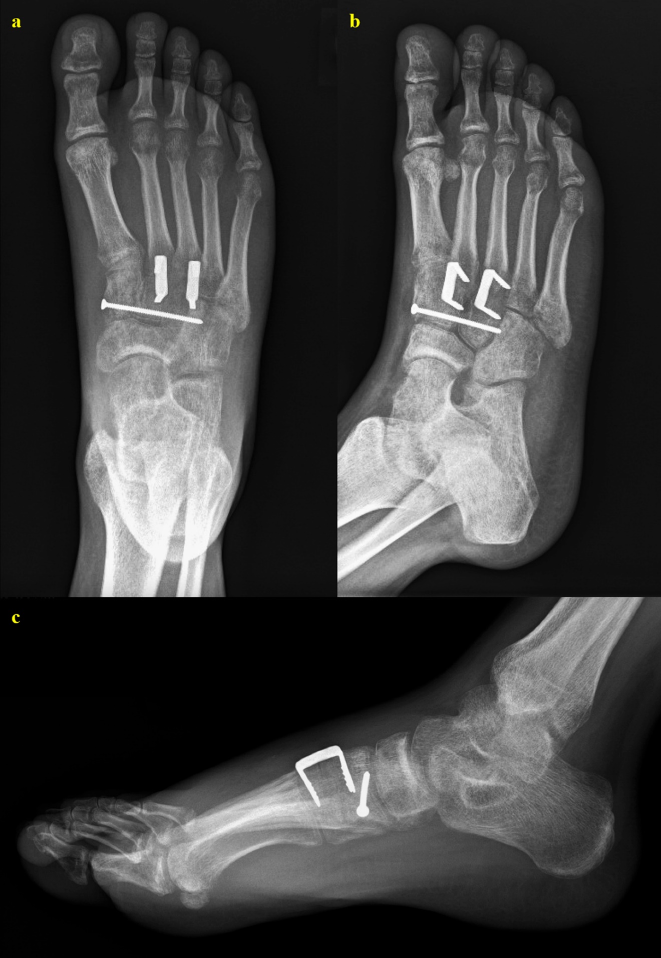 A Rare Case of a Lisfranc Ligament Transection Published in