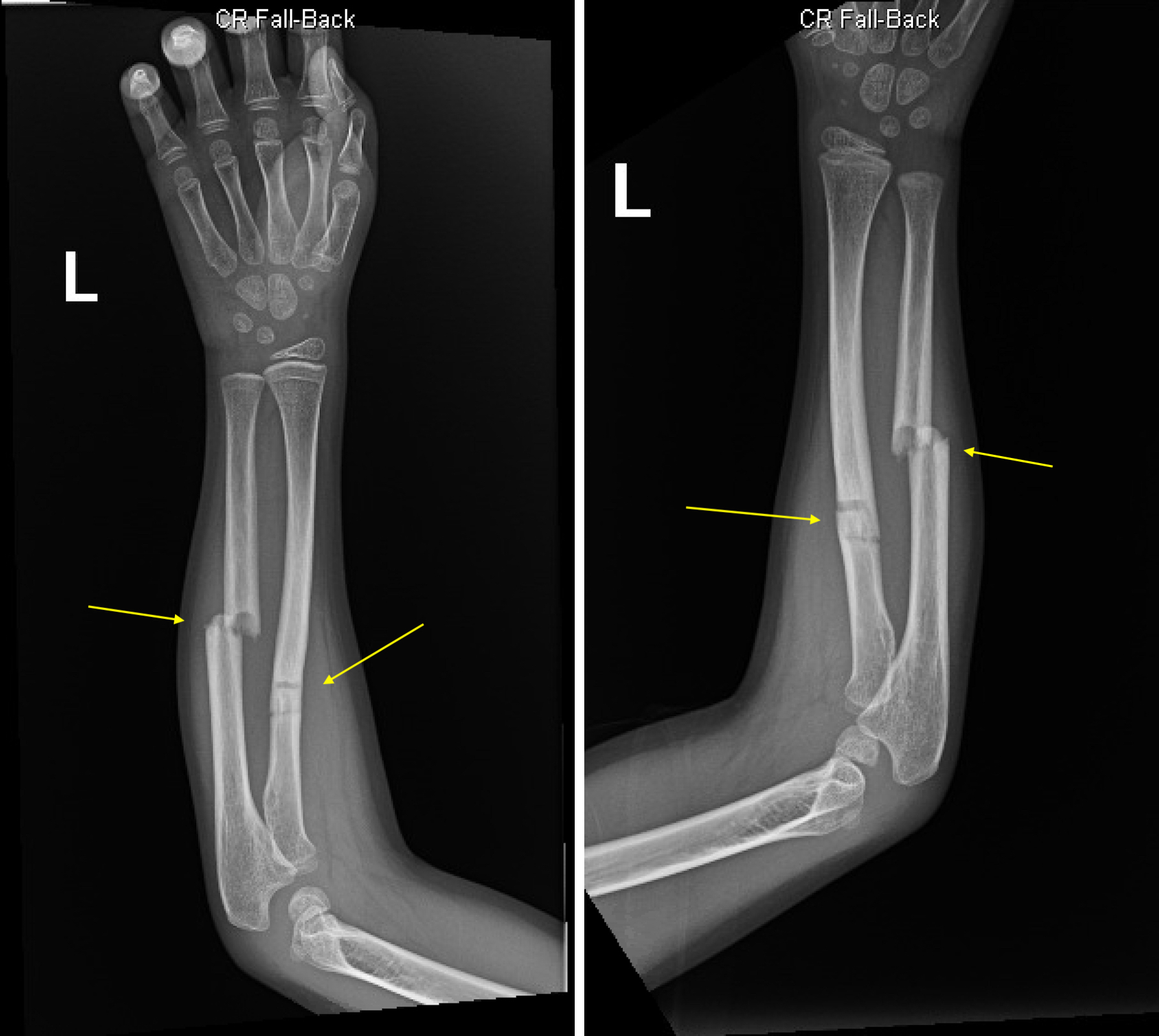 Greenstick Fractures Of The Mid Radial And Ulnar Diaphysis With Volar 