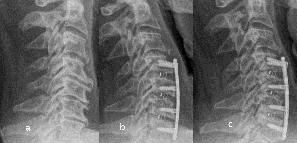 Follow-up of a new titanium cervical plate for fusion of the