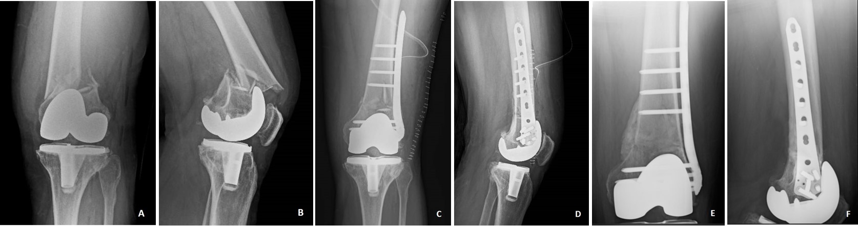 Periprosthetic distal femoral fractures after total knee replacement ...