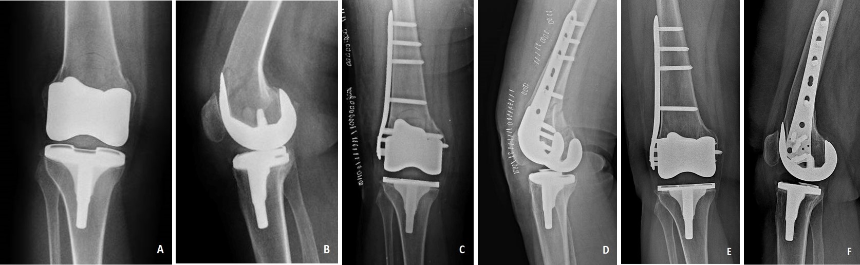 Medicina | Free Full-Text | Risk Factors Associated with Intraoperative  Iatrogenic Fracture in Patients Undergoing Intramedullary Nailing for  Atypical Femoral Fractures with Marked Anterior and Lateral Bowing