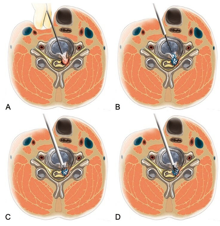 Giant inguinal hernia repair using standard transverse inguinal incision  with mesh. A retrospective case control study, BMC Surgery