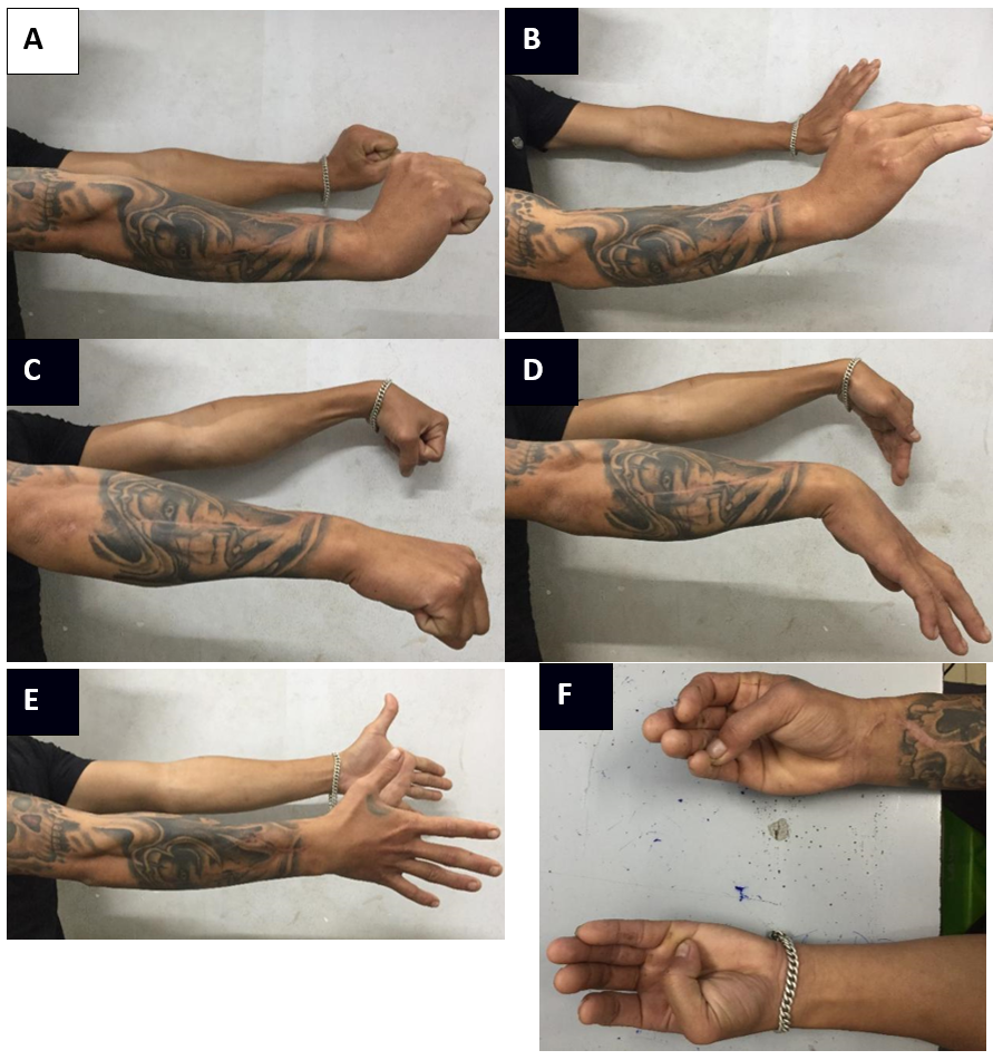 TREATMENT OF IRRECOVERABLE RADIAL NERVE PALSY USING THE MODIFIED MERLE ...